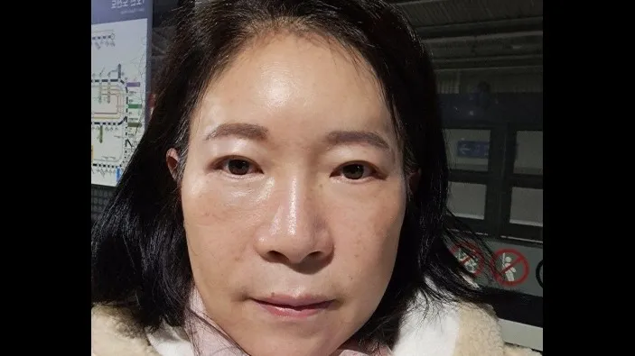 Sub-brow Lift, Lower Blepharoplasty (Aging Eye Rejuvenation), Midface Lift — RE&RE PLASTIC SURGERY 3