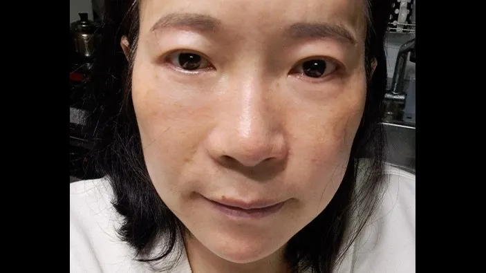 Sub-brow Lift, Lower Blepharoplasty (Aging Eye Rejuvenation), Midface Lift — RE&RE PLASTIC SURGERY 5