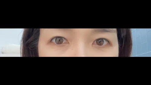 Sub-brow Lift — RE&RE PLASTIC SURGERY 2