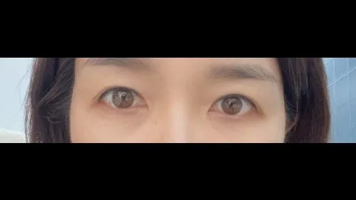 Sub-brow Lift — RE&RE PLASTIC SURGERY 3