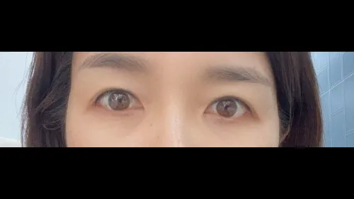 Sub-brow Lift — RE&RE PLASTIC SURGERY 4