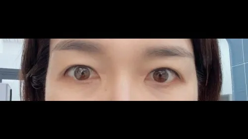 Sub-brow Lift — RE&RE PLASTIC SURGERY 5