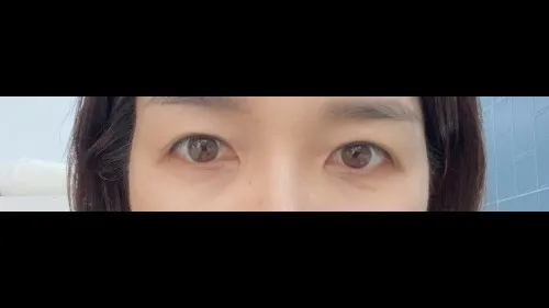 Sub-brow Lift — RE&RE PLASTIC SURGERY 6