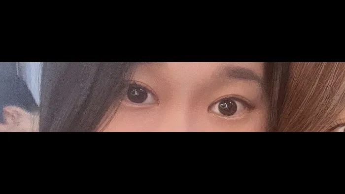 Natural Adhesion Double Eyelid Surgery, Ptosis Correction — RE&RE PLASTIC SURGERY 2