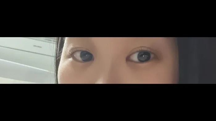 Natural Adhesion Double Eyelid Surgery, Ptosis Correction — RE&RE PLASTIC SURGERY 3