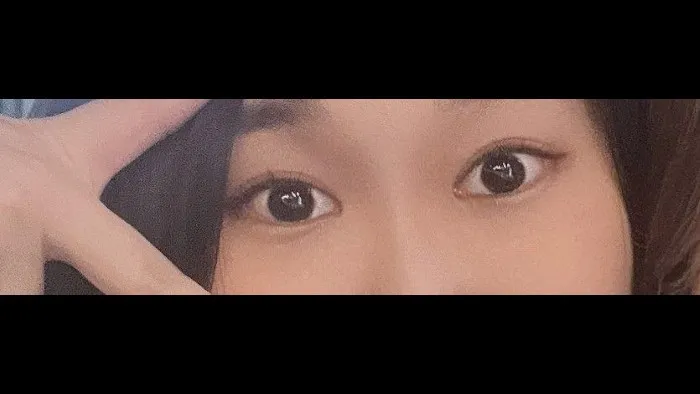 Natural Adhesion Double Eyelid Surgery, Ptosis Correction — RE&RE PLASTIC SURGERY 4