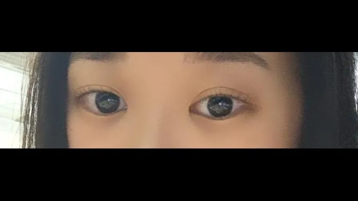 Natural Adhesion Double Eyelid Surgery, Ptosis Correction — RE&RE PLASTIC SURGERY 5