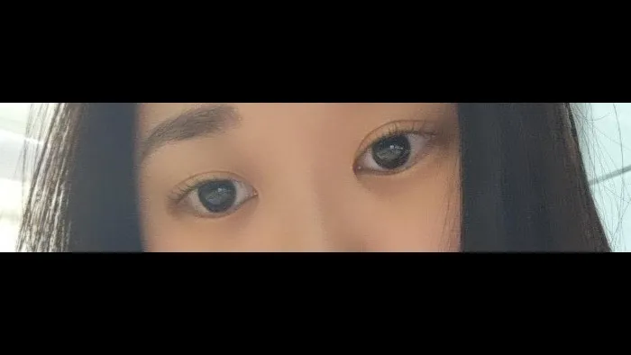 Natural Adhesion Double Eyelid Surgery, Ptosis Correction — RE&RE PLASTIC SURGERY 6