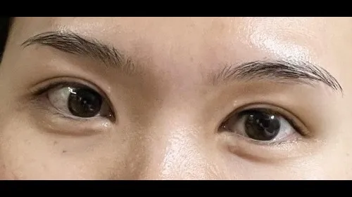 Incisional Double Eyelid Surgery — RE&RE PLASTIC SURGERY 2