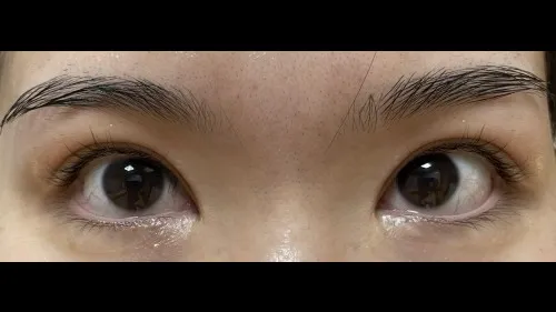 Incisional Double Eyelid Surgery — RE&RE PLASTIC SURGERY 3