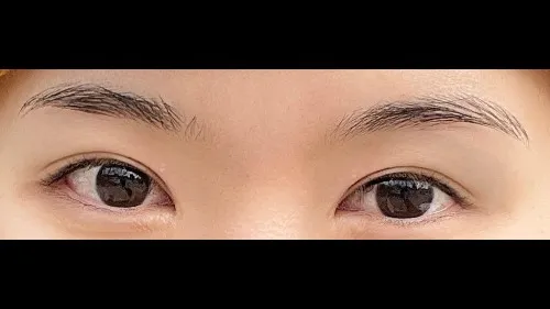 Incisional Double Eyelid Surgery — RE&RE PLASTIC SURGERY 4