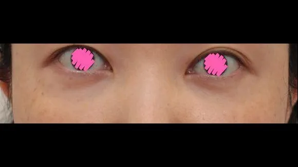 眼底脂肪重排, 下眼睑手术(中老年眼整形) 1