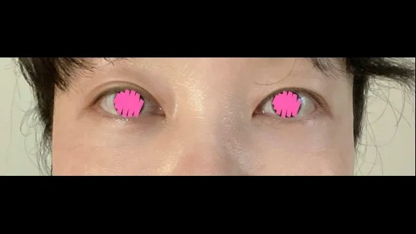 目の下脂肪再配置, 下眼瞼形成(中高年の目元) — RE&RE PLASTIC SURGERY 2