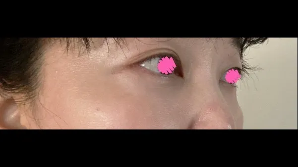 目の下脂肪再配置, 下眼瞼形成(中高年の目元) — RE&RE PLASTIC SURGERY 3
