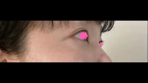 目の下脂肪再配置, 下眼瞼形成(中高年の目元) — RE&RE PLASTIC SURGERY 4