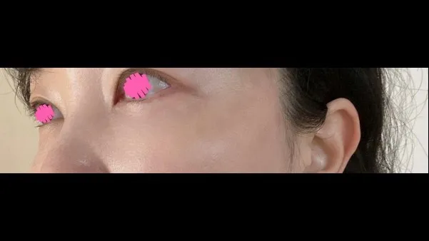 目の下脂肪再配置, 下眼瞼形成(中高年の目元) — RE&RE PLASTIC SURGERY 5
