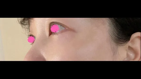 目の下脂肪再配置, 下眼瞼形成(中高年の目元) — RE&RE PLASTIC SURGERY 6