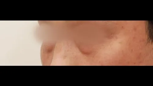 Lower Blepharoplasty (Aging Eye Rejuvenation), Midface Lift — RE&RE PLASTIC SURGERY 2