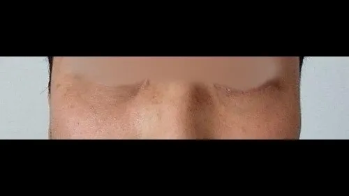 Lower Blepharoplasty (Aging Eye Rejuvenation), Midface Lift — RE&RE PLASTIC SURGERY 3