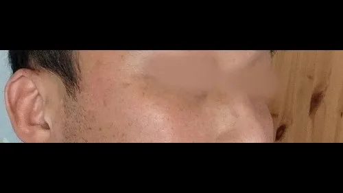 Lower Blepharoplasty (Aging Eye Rejuvenation), Midface Lift — RE&RE PLASTIC SURGERY 4
