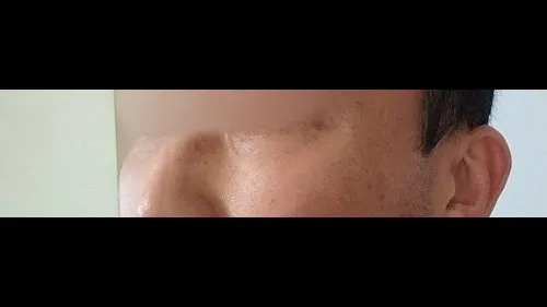 Lower Blepharoplasty (Aging Eye Rejuvenation), Midface Lift — RE&RE PLASTIC SURGERY 5