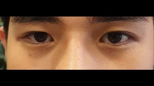 Incisional Double Eyelid Surgery, Ptosis Correction, Lower Eyelid Fat Grafting, Facial Fat Grafting — RE&RE PLASTIC SURGERY 1