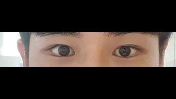 Incisional Double Eyelid Surgery, Ptosis Correction, Lower Eyelid Fat Grafting, Facial Fat Grafting — RE&RE PLASTIC SURGERY 2