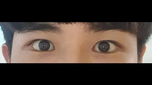 Incisional Double Eyelid Surgery, Ptosis Correction, Lower Eyelid Fat Grafting, Facial Fat Grafting — RE&RE PLASTIC SURGERY 3