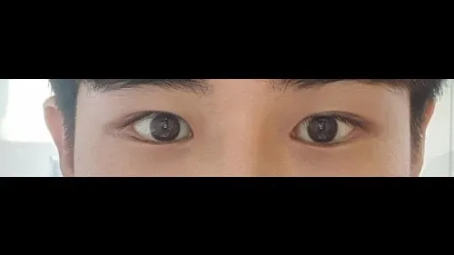 Incisional Double Eyelid Surgery, Ptosis Correction, Lower Eyelid Fat Grafting, Facial Fat Grafting — RE&RE PLASTIC SURGERY 4