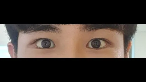 Incisional Double Eyelid Surgery, Ptosis Correction, Lower Eyelid Fat Grafting, Facial Fat Grafting — RE&RE PLASTIC SURGERY 5