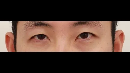 Incisional Double Eyelid Surgery, Ptosis Correction — RE&RE PLASTIC SURGERY 1