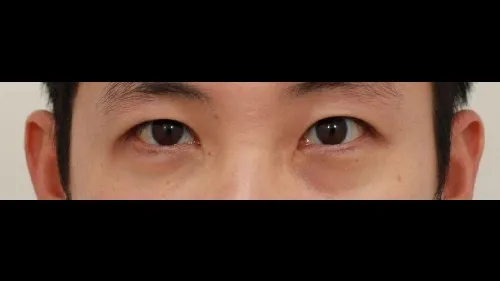 Incisional Double Eyelid Surgery, Ptosis Correction — RE&RE PLASTIC SURGERY 2