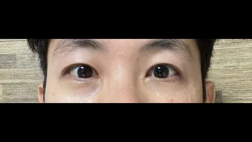 Incisional Double Eyelid Surgery, Ptosis Correction — RE&RE PLASTIC SURGERY 3
