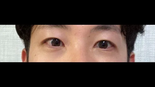 Incisional Double Eyelid Surgery, Ptosis Correction — RE&RE PLASTIC SURGERY 4