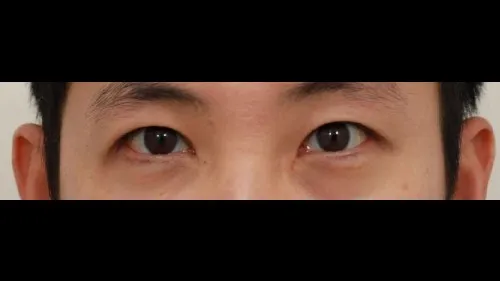 Incisional Double Eyelid Surgery, Ptosis Correction — RE&RE PLASTIC SURGERY 5