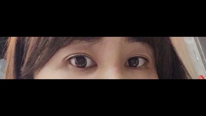 Sub-brow Lift, Lower Eyelid Fat Grafting — RE&RE PLASTIC SURGERY 2