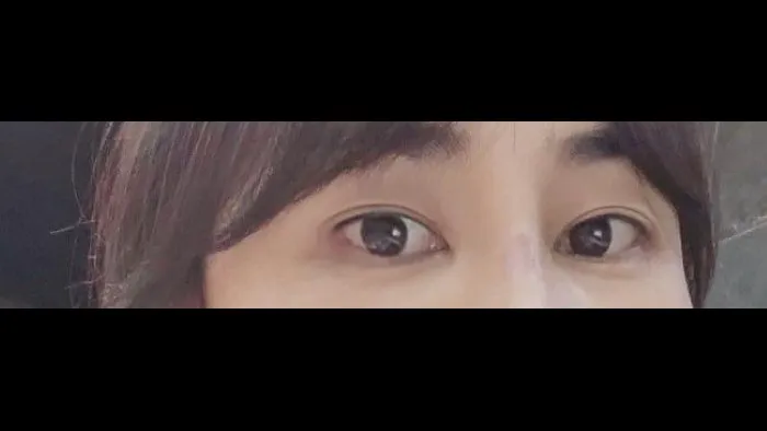 Sub-brow Lift, Lower Eyelid Fat Grafting — RE&RE PLASTIC SURGERY 3