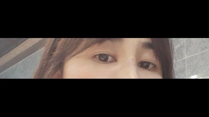 Sub-brow Lift, Lower Eyelid Fat Grafting — RE&RE PLASTIC SURGERY 5