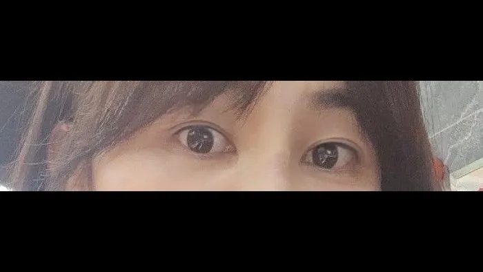 Sub-brow Lift, Lower Eyelid Fat Grafting — RE&RE PLASTIC SURGERY 6