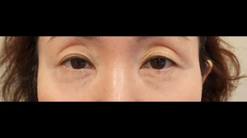 Sub-brow Lift, Lower Eyelid Fat Grafting, Lower Blepharoplasty (Aging Eye Rejuvenation), Midface Lift, Full facelift 1