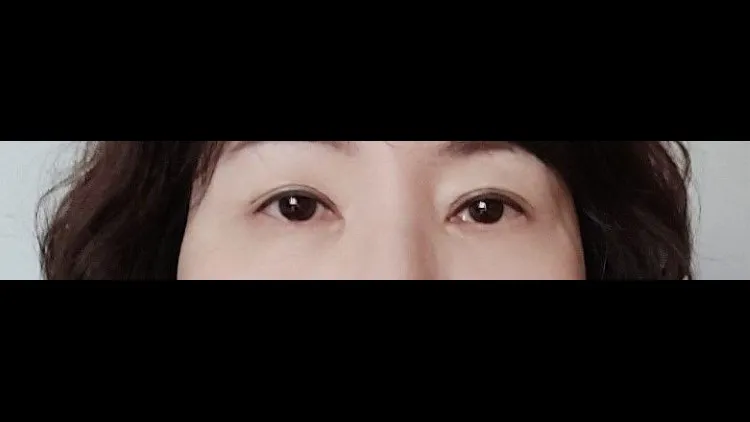 眉下リフト, 目の下脂肪移植, 下眼瞼形成（中高年の目元）, 中顔面リフト, フルフェイスリフト 2