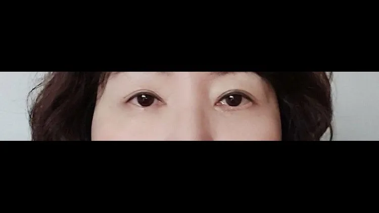 Sub-brow Lift, Lower Eyelid Fat Grafting, Lower Blepharoplasty (Aging Eye Rejuvenation), Midface Lift, Full facelift — RE&RE PLASTIC SURGERY 3