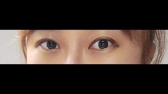 Natural Adhesion Double Eyelid Surgery, Ptosis Correction — RE&RE PLASTIC SURGERY 2