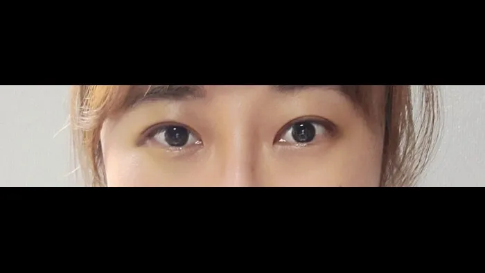 Natural Adhesion Double Eyelid Surgery, Ptosis Correction — RE&RE PLASTIC SURGERY 3
