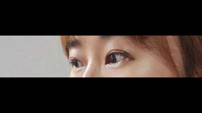 Natural Adhesion Double Eyelid Surgery, Ptosis Correction — RE&RE PLASTIC SURGERY 4