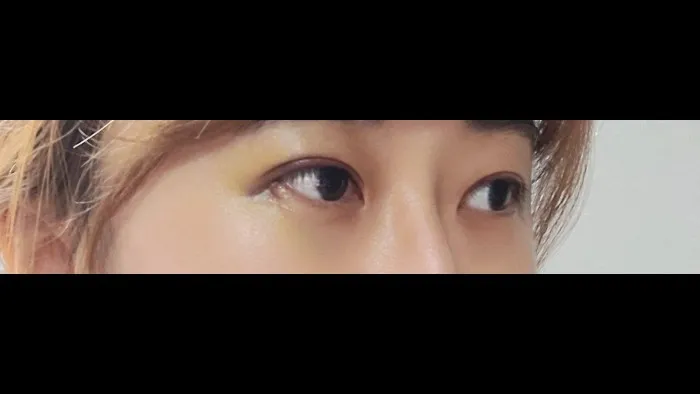 Natural Adhesion Double Eyelid Surgery, Ptosis Correction — RE&RE PLASTIC SURGERY 5