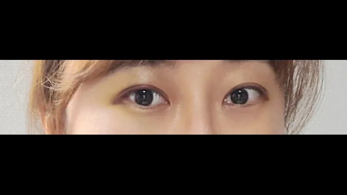 Natural Adhesion Double Eyelid Surgery, Ptosis Correction — RE&RE PLASTIC SURGERY 6