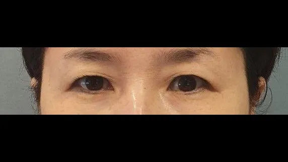 Sub-brow Lift — RE&RE PLASTIC SURGERY 2