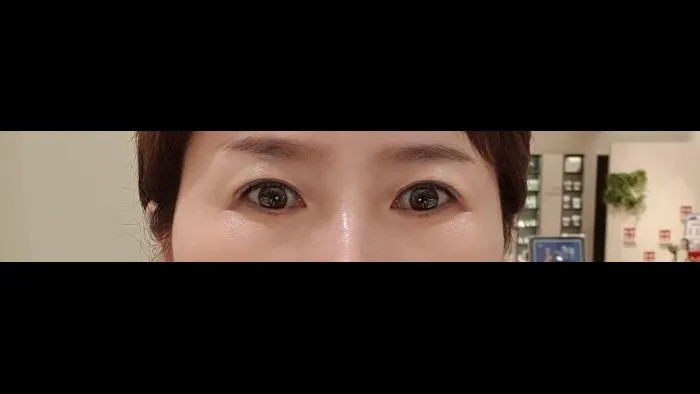Sub-brow Lift — RE&RE PLASTIC SURGERY 4