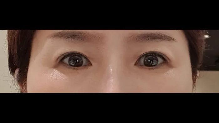 Sub-brow Lift — RE&RE PLASTIC SURGERY 5